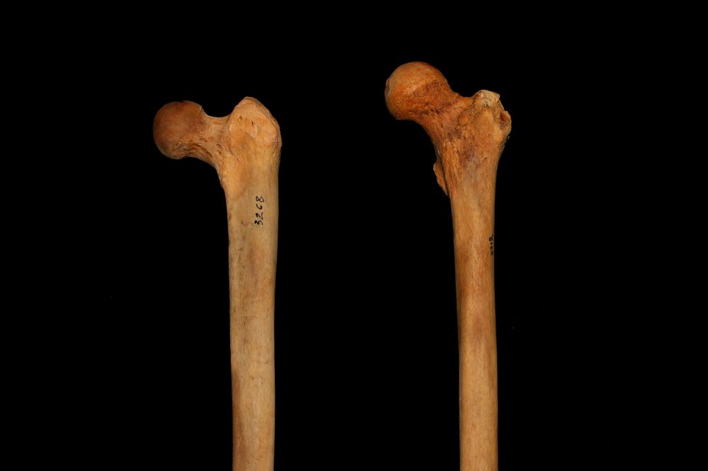 femur