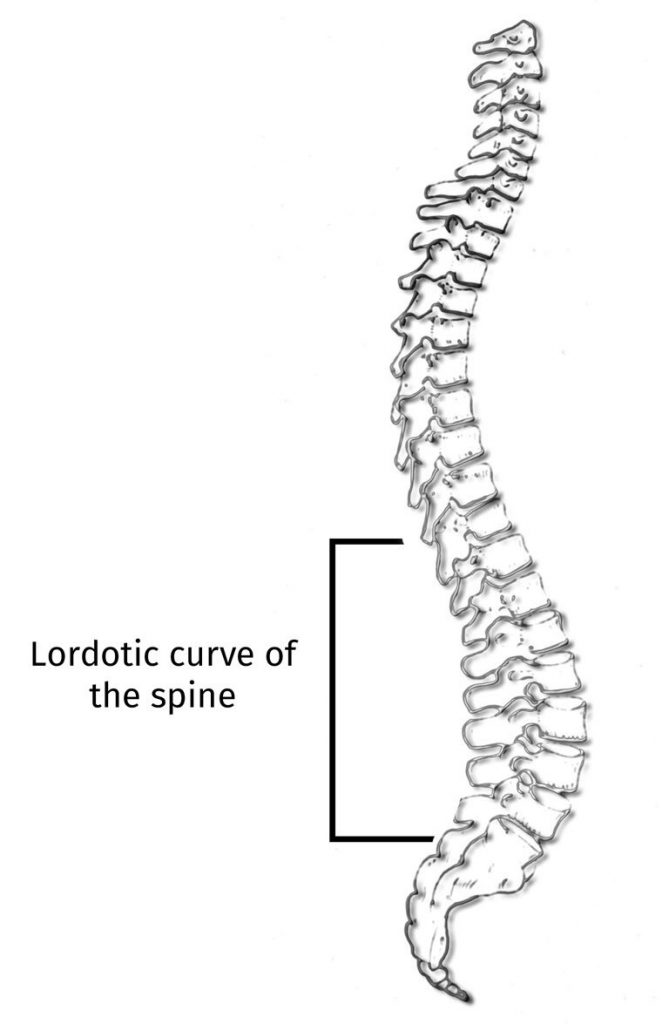 Lordotic curve